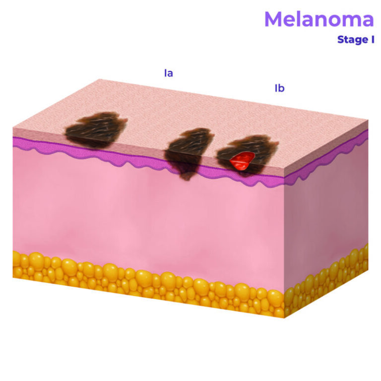 Stages of Melanoma - AIM at Melanoma Foundation