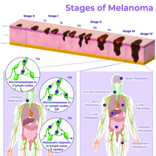 early-malignant-melanoma-in-situ