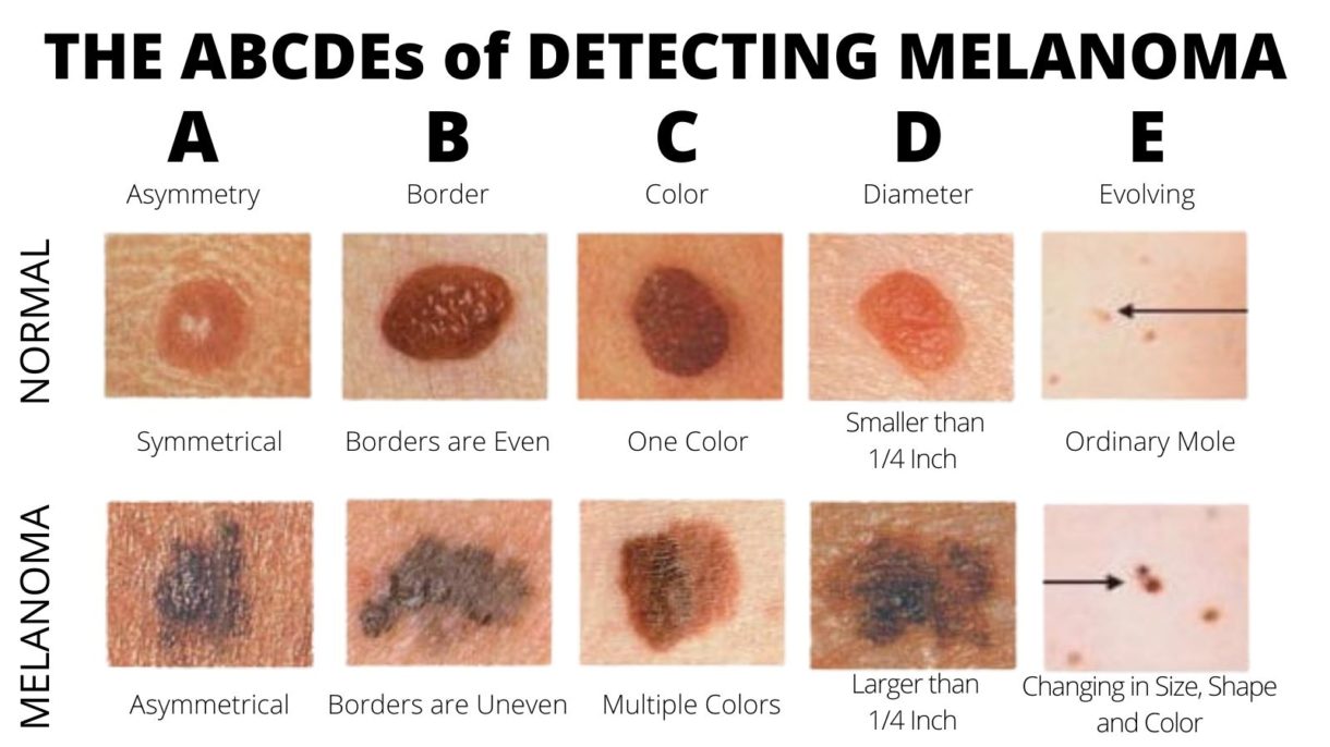 Types Of Moles On The Body
