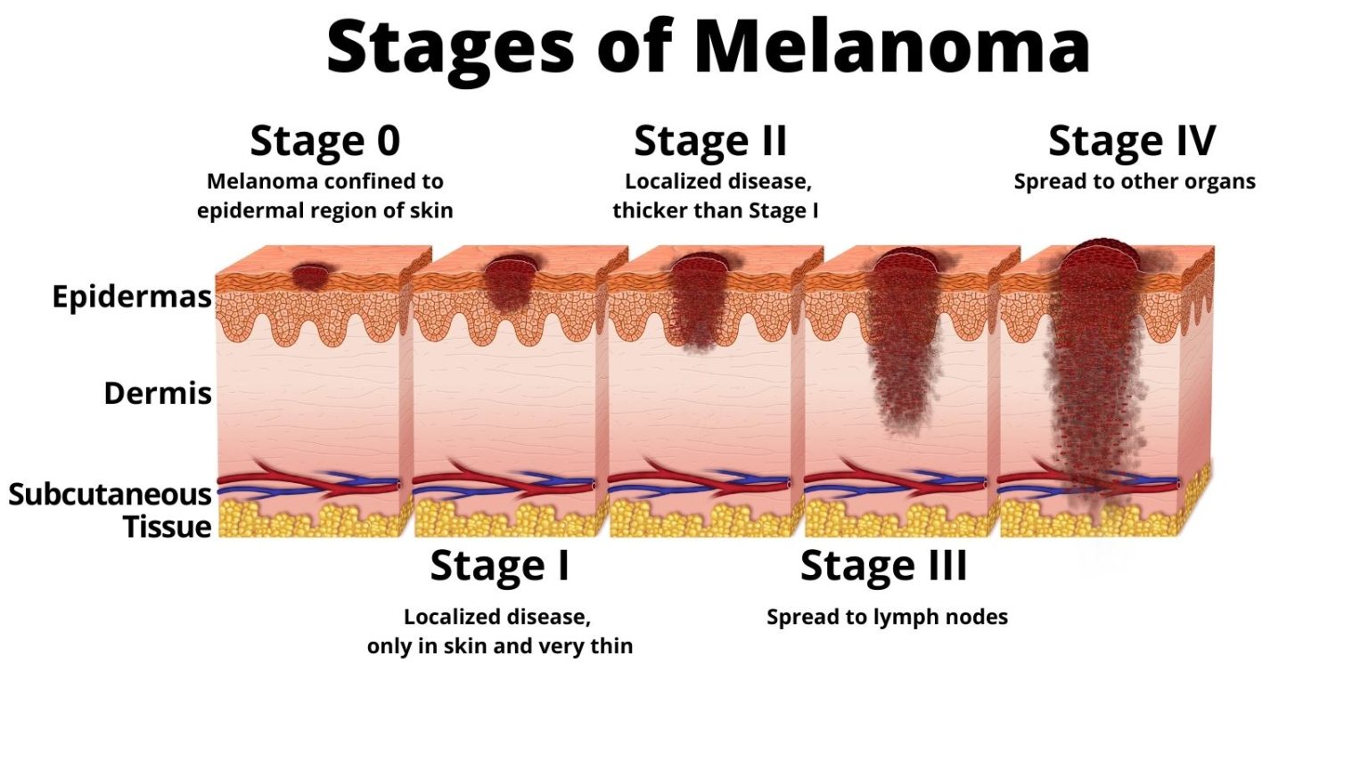 Stages of Melanoma - AIM at Melanoma Foundation
