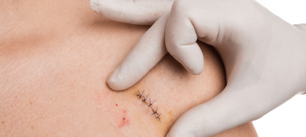 Skin Biopsy: The First Step