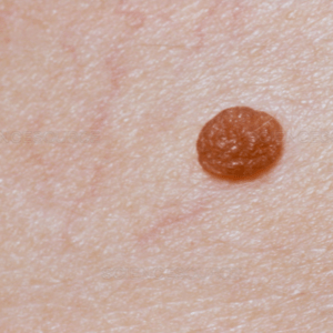 Types Moles and Skin Lesions at Melanoma Foundation