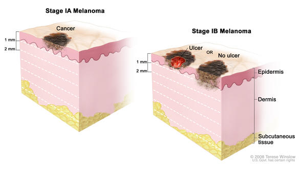 Understanding Melanoma: Treatment Options for Stage I Melanoma