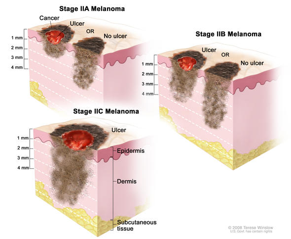 Understanding Melanoma: Treatment Options for Stage II Melanoma