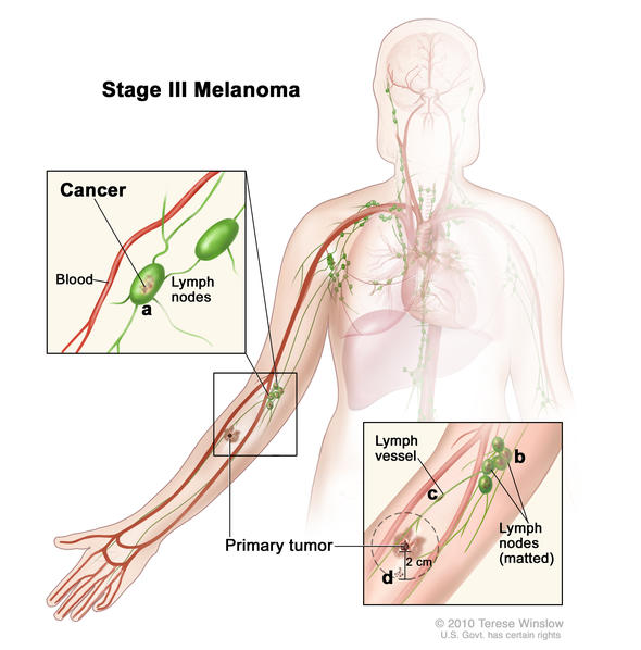 melanoma