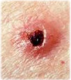 Other Skin Cancers - AIM at Melanoma Foundation